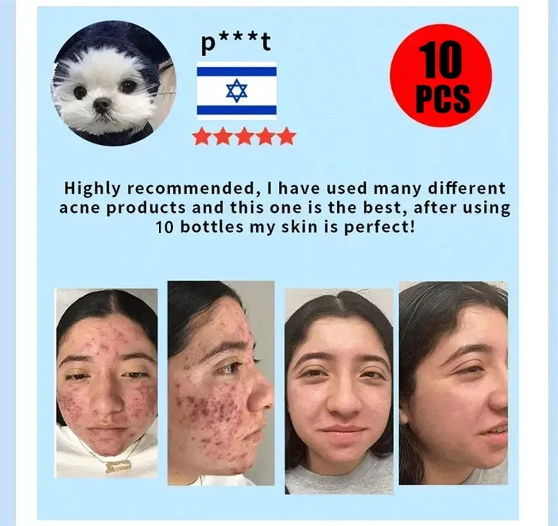 Salicylic Acid Acne Serum Cream Effective Treatment Hip Butt Acne Face Acne Back Acne Fade Acne Marks Whitening Smooth Skin Care