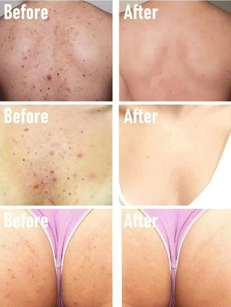 Salicylic Acid Acne Serum Cream Effective Treatment Hip Butt Acne Face Acne Back Acne Fade Acne Marks Whitening Smooth Skin Care