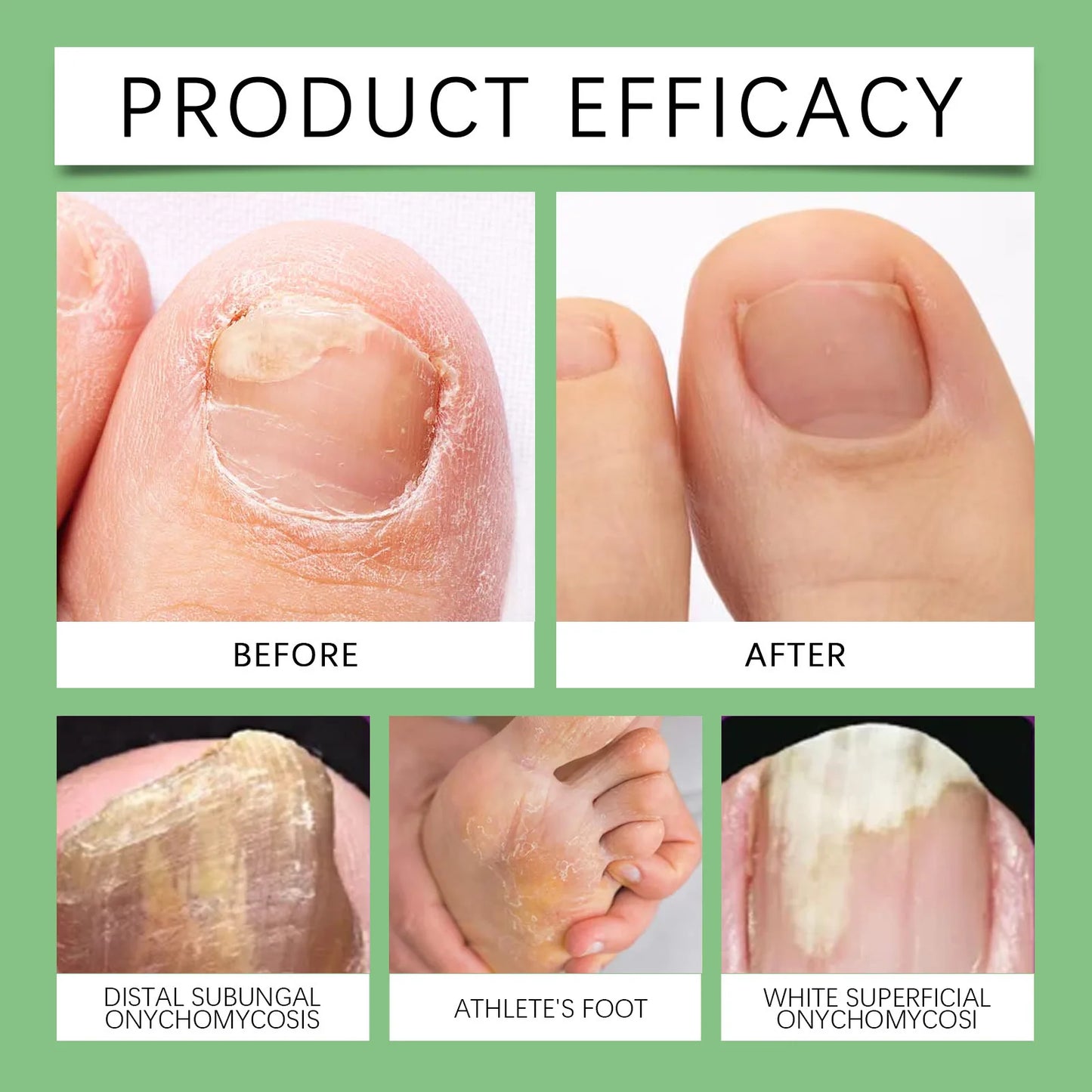 South Moon Nail Treatment Spray Onychomycosis Hand Foot Removal Repair Paronychia Strong Bright Nail Soft Nail Fungus Solution