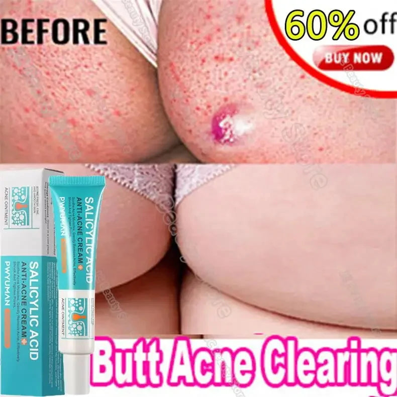Salicylic Acid Acne Serum Cream Effective Treatment Hip Butt Acne Face Acne Back Acne Fade Acne Marks Whitening Smooth Skin Care