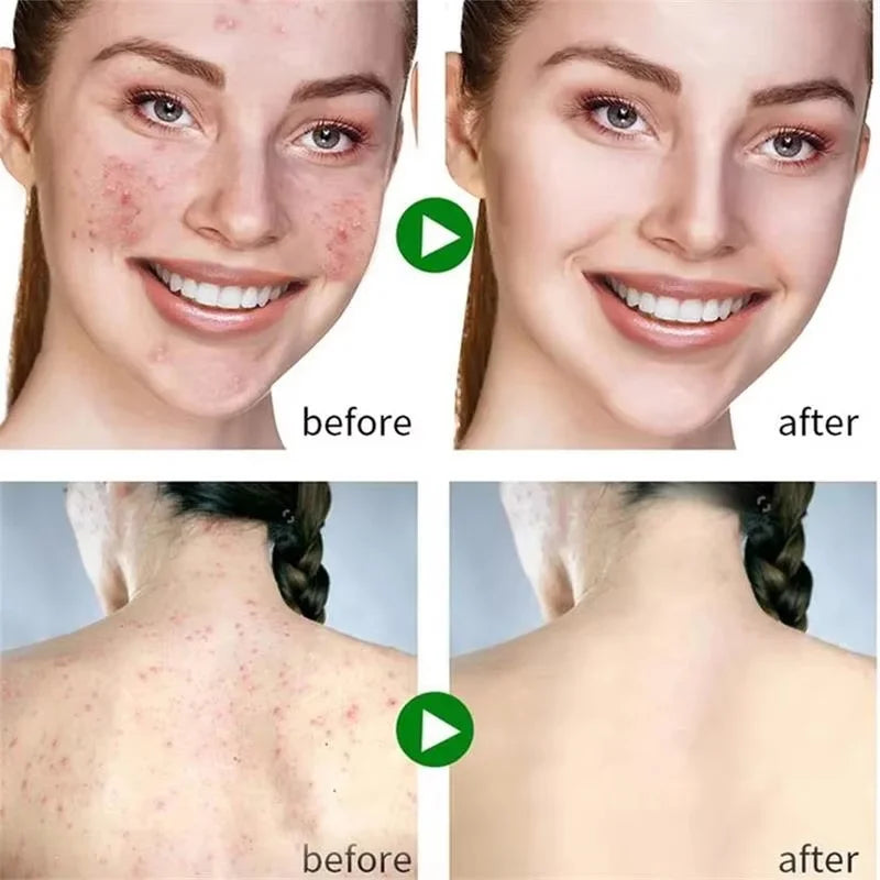 Salicylic Acid Acne Serum Cream Effective Treatment Hip Butt Acne Face Acne Back Acne Fade Acne Marks Whitening Smooth Skin Care