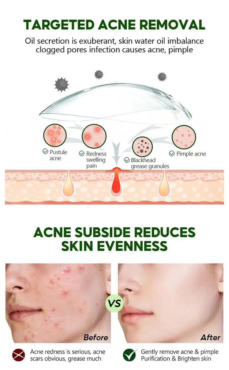 Salicylic Acid Acne Serum Cream Effective Treatment Hip Butt Acne Face Acne Back Acne Fade Acne Marks Whitening Smooth Skin Care