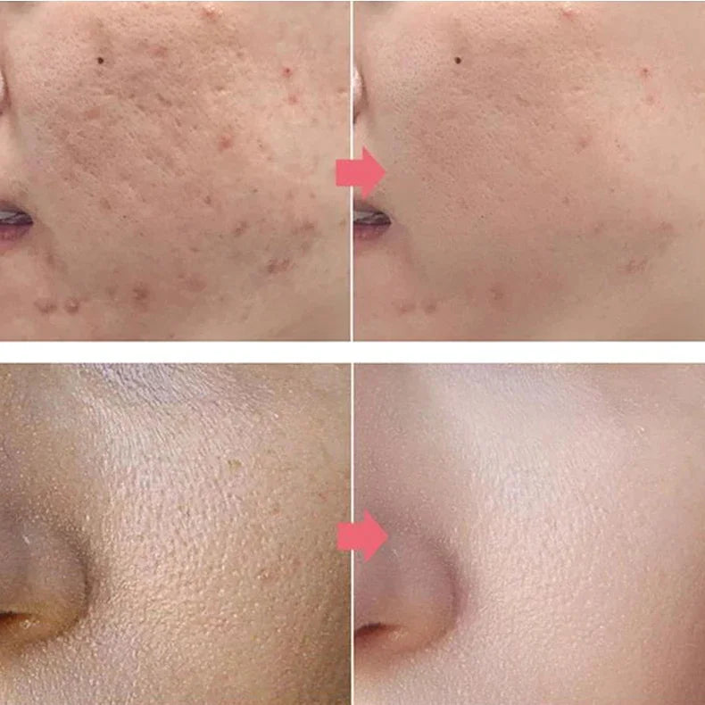 Salicylic Acid Acne Serum Cream Effective Treatment Hip Butt Acne Face Acne Back Acne Fade Acne Marks Whitening Smooth Skin Care