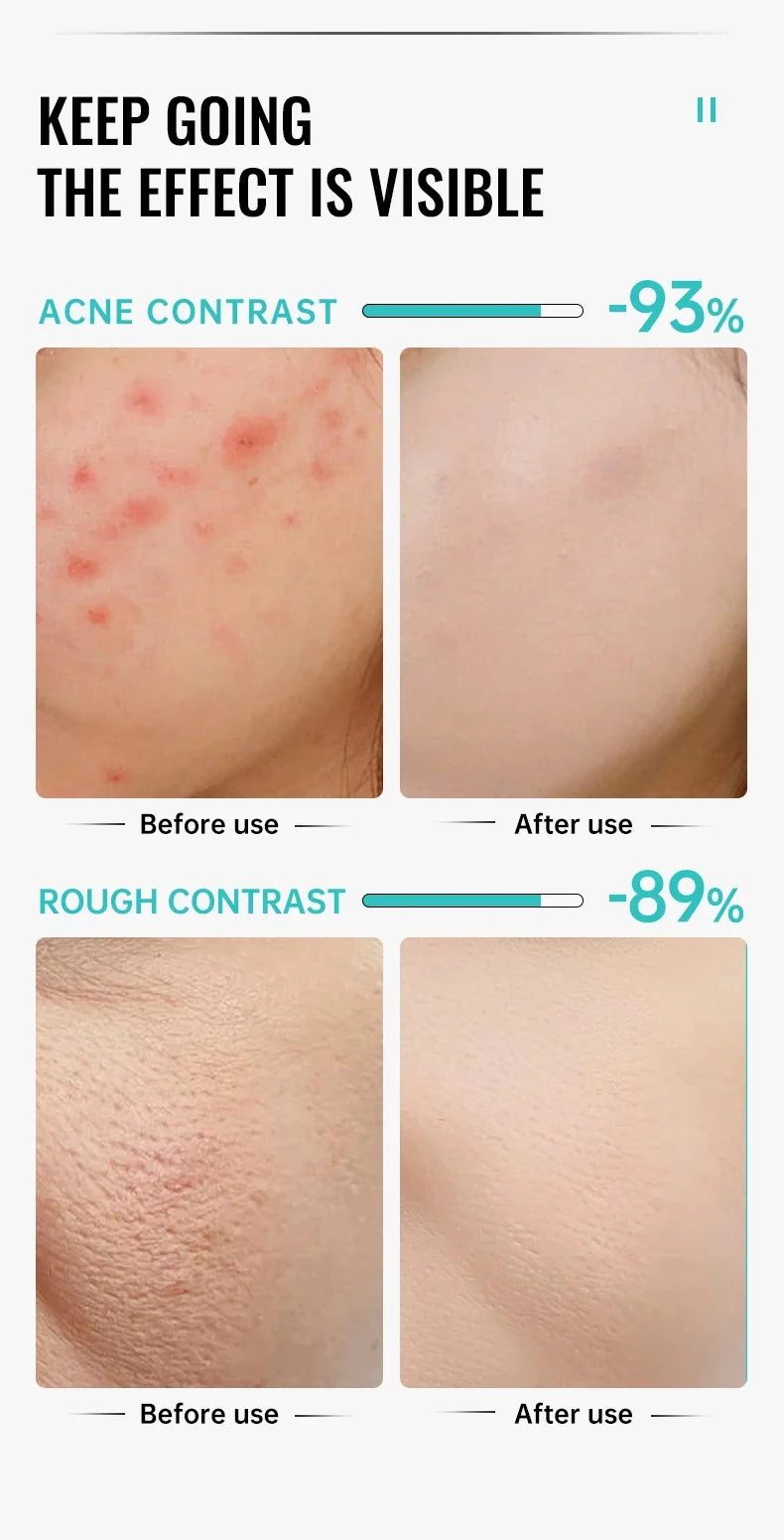 Salicylic Acid Acne Serum Cream Effective Treatment Hip Butt Acne Face Acne Back Acne Fade Acne Marks Whitening Smooth Skin Care