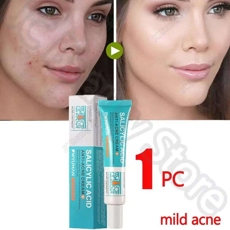 Salicylic Acid Acne Serum Cream Effective Treatment Hip Butt Acne Face Acne Back Acne Fade Acne Marks Whitening Smooth Skin Care