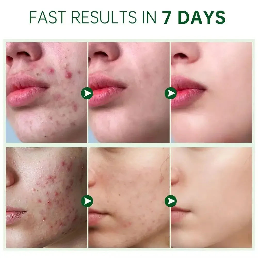 Salicylic Acid Acne Treatment Face Cream Repair Pimple Spots Deep Cleaning Pore Anti-acne Scar Oil Control Moisturizer Skin Care
