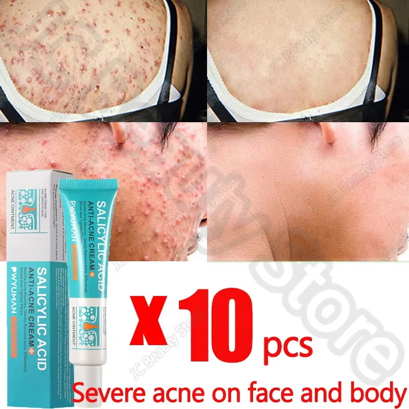 Salicylic Acid Acne Serum Cream Effective Treatment Hip Butt Acne Face Acne Back Acne Fade Acne Marks Whitening Smooth Skin Care