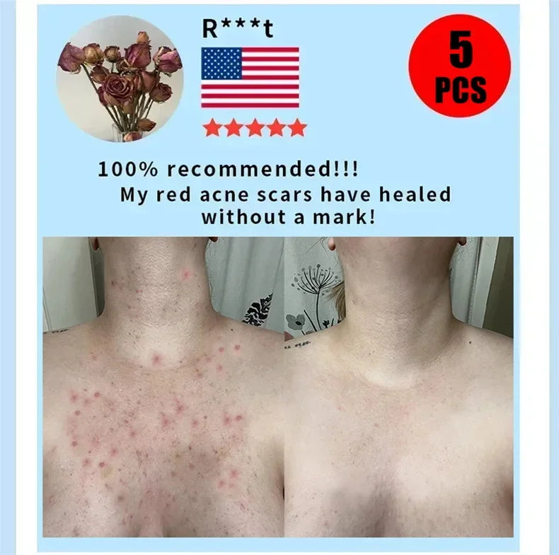 Salicylic Acid Acne Serum Cream Effective Treatment Hip Butt Acne Face Acne Back Acne Fade Acne Marks Whitening Smooth Skin Care