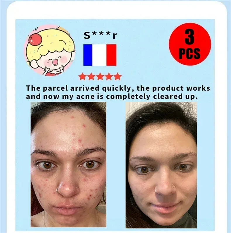 Salicylic Acid Acne Serum Cream Effective Treatment Hip Butt Acne Face Acne Back Acne Fade Acne Marks Whitening Smooth Skin Care