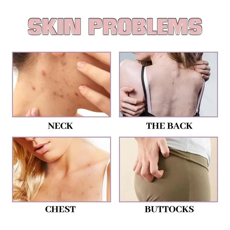Salicylic Acid Acne Serum Cream Effective Treatment Hip Butt Acne Face Acne Back Acne Fade Acne Marks Whitening Smooth Skin Care