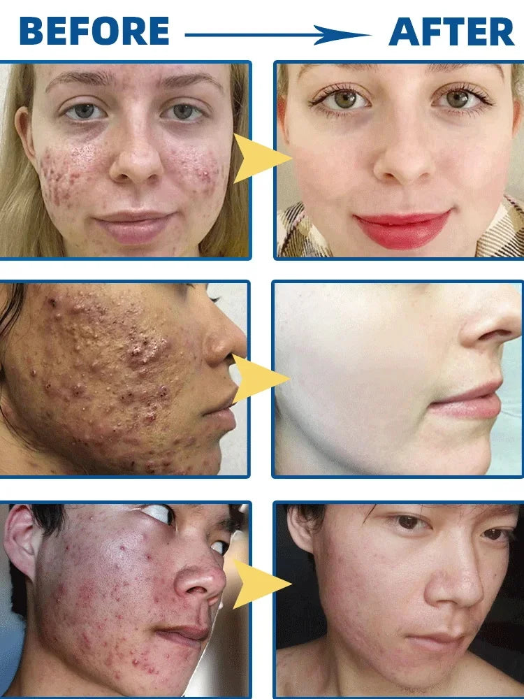 Salicylic Acid Acne Serum Cream Effective Treatment Hip Butt Acne Face Acne Back Acne Fade Acne Marks Whitening Smooth Skin Care