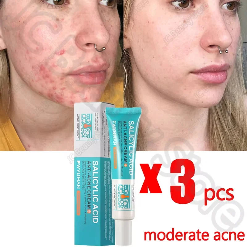Salicylic Acid Acne Serum Cream Effective Treatment Hip Butt Acne Face Acne Back Acne Fade Acne Marks Whitening Smooth Skin Care
