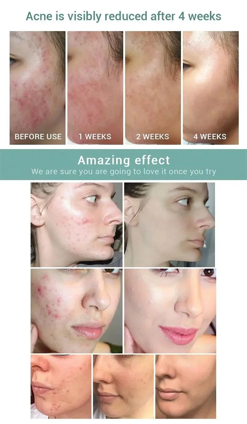 Salicylic Acid Acne Serum Cream Effective Treatment Hip Butt Acne Face Acne Back Acne Fade Acne Marks Whitening Smooth Skin Care
