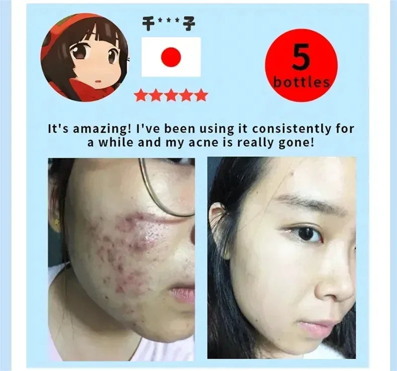 Salicylic Acid Acne Serum Cream Effective Treatment Hip Butt Acne Face Acne Back Acne Fade Acne Marks Whitening Smooth Skin Care