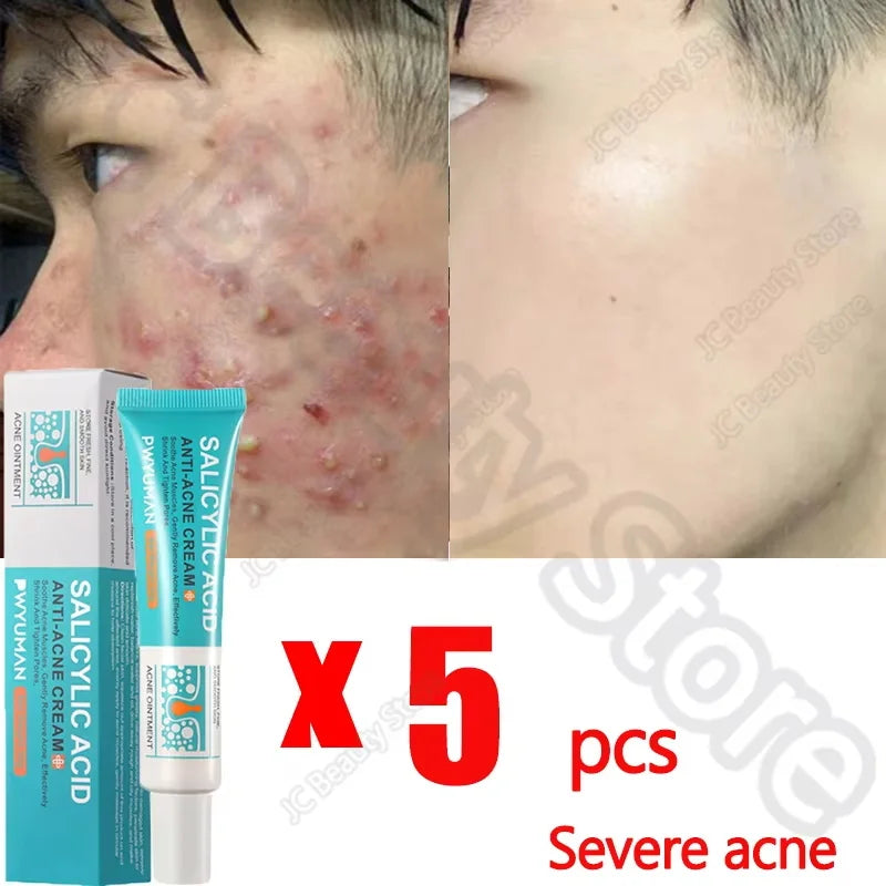 Salicylic Acid Acne Serum Cream Effective Treatment Hip Butt Acne Face Acne Back Acne Fade Acne Marks Whitening Smooth Skin Care